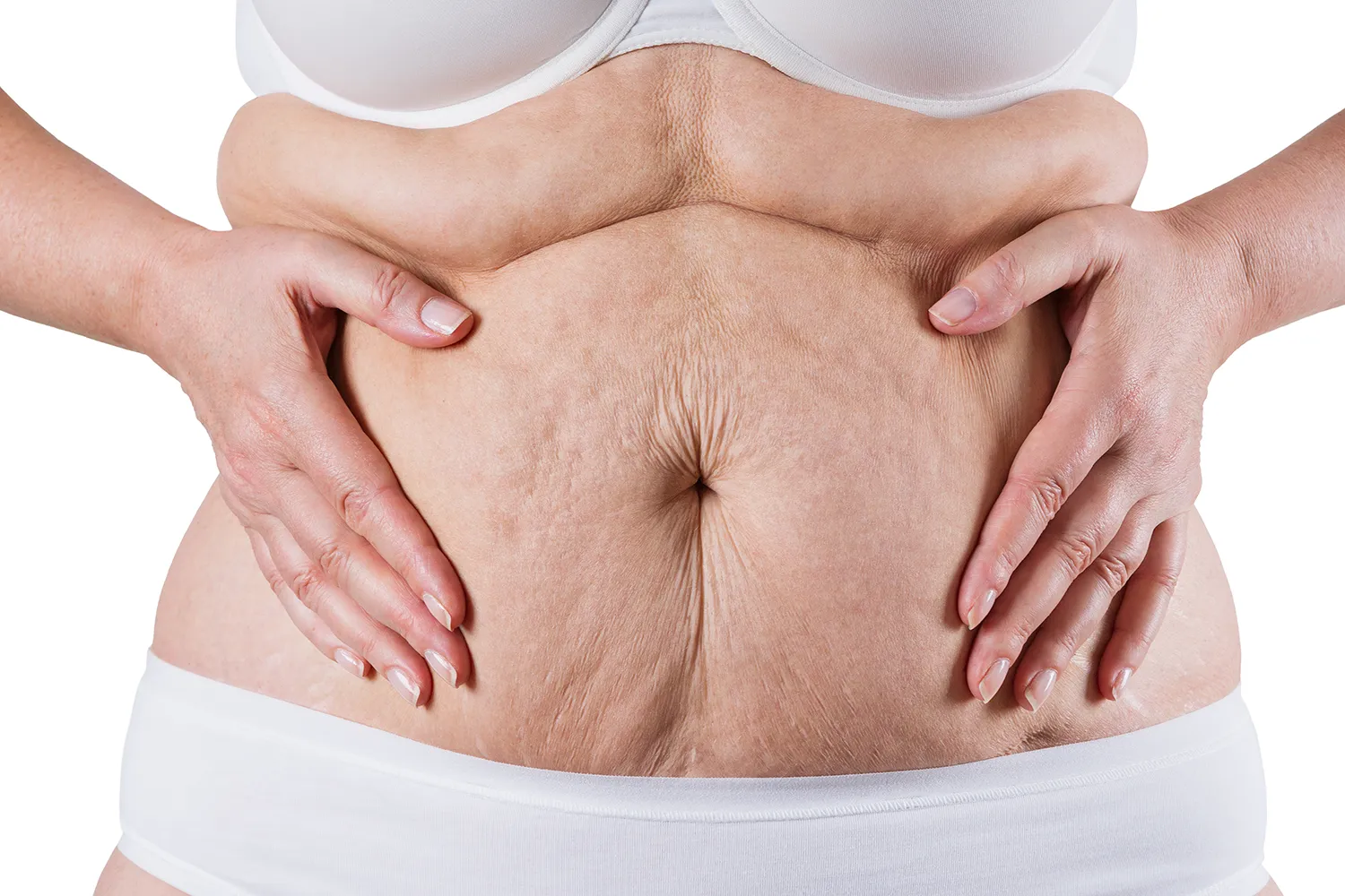 Abdominoplasti