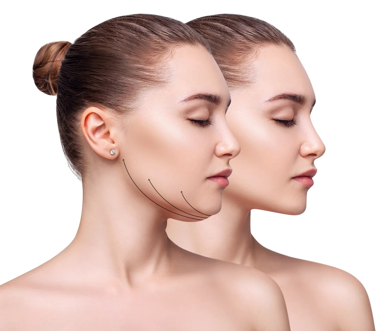 Lipoaspiration