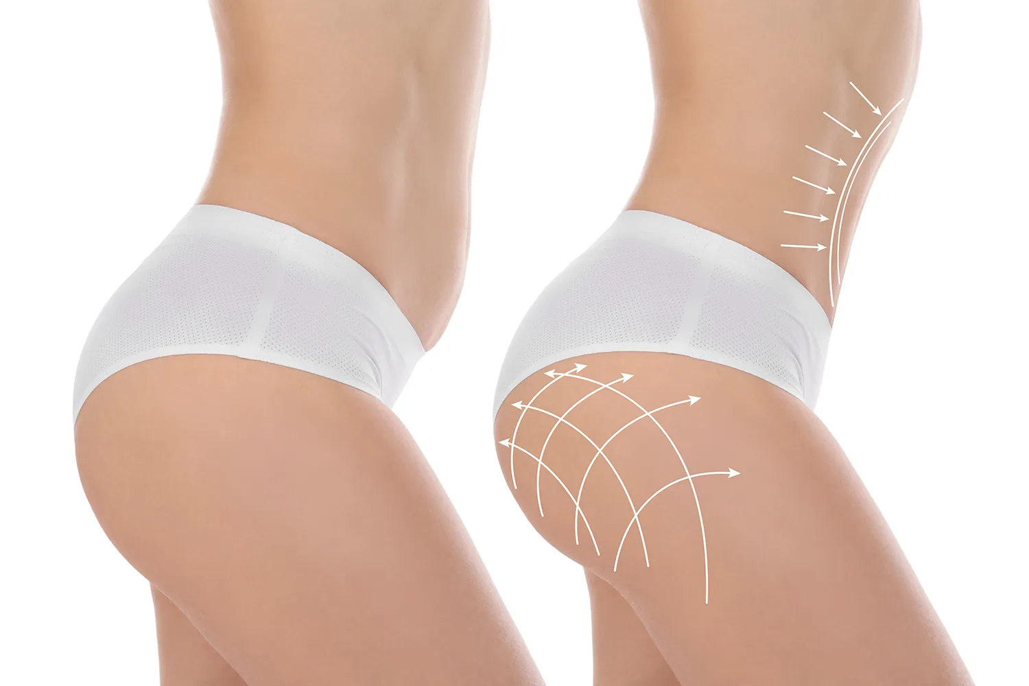 Lipofilling fessier