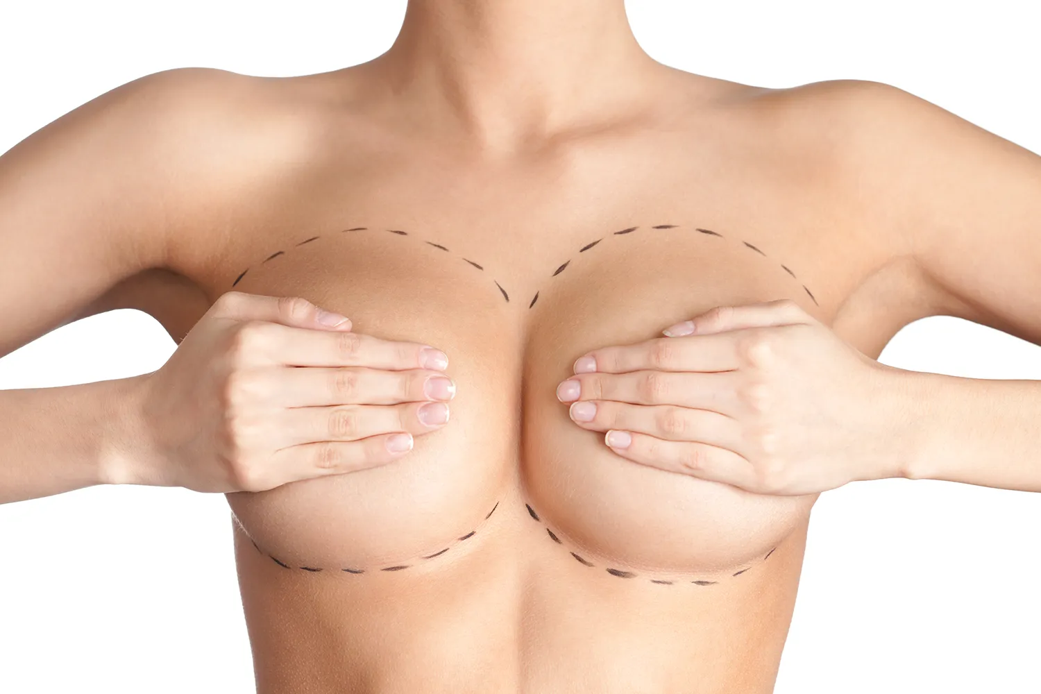 Lipofilling mammaire